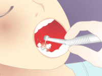 歯の治療について⑦